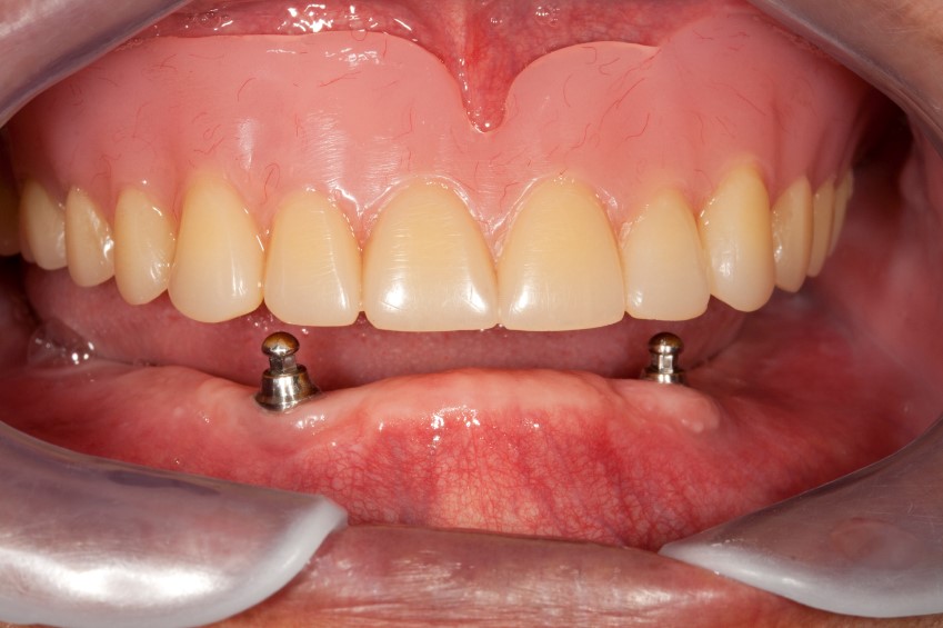 Upper Partial Dentures Ridgely MD 21685